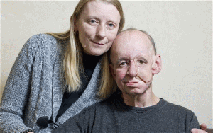 face, prosthetic, UK, doctor, surgery, medicine