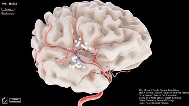 A Simulation for Successful Brain Surgery - Engineering.com